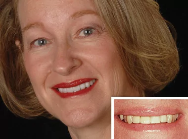 Woman smiling after dental implant treatment at La Costa Dental Excellence in Carlsbad, CA