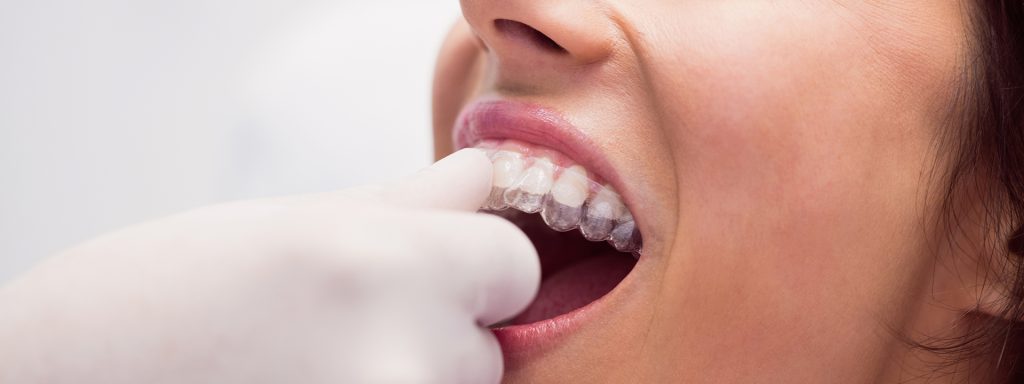 Woman holding clear aligner trays, supported by Invisalign treatment at La Costa Dental Excellence in Carlsbad, CA