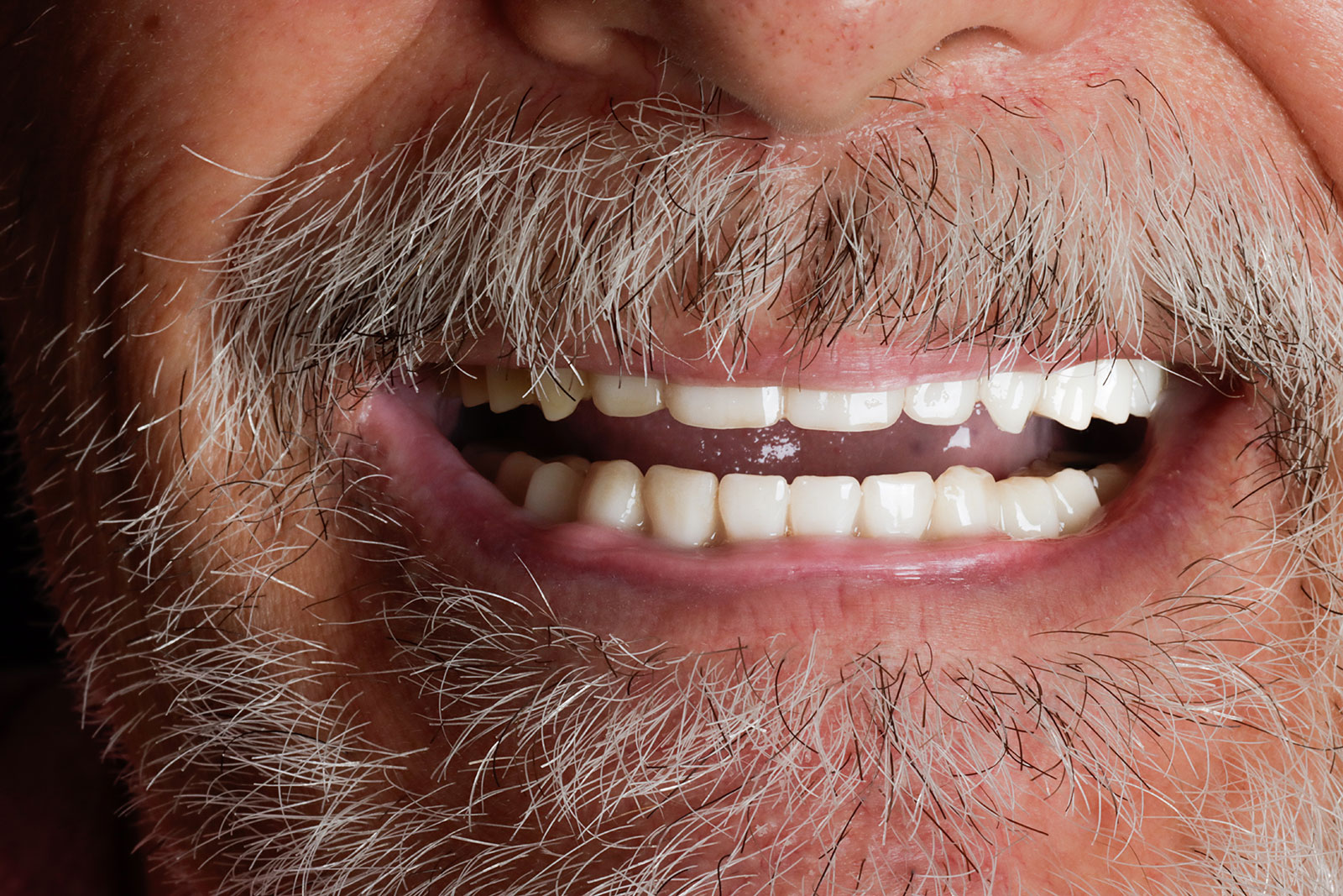 Close-up of the same man's smile after fixed zirconia implant bridges on both arches at La Costa Dental Excellence in Carlsbad, CA