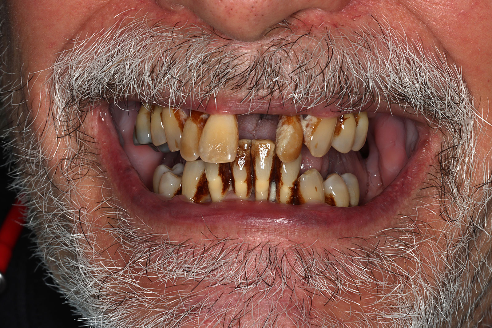 Close-up of a man's smile before full-arch dental implant treatment, showing heavy staining, worn edges, and missing teeth, at La Costa Dental Excellence in Carlsbad, CA