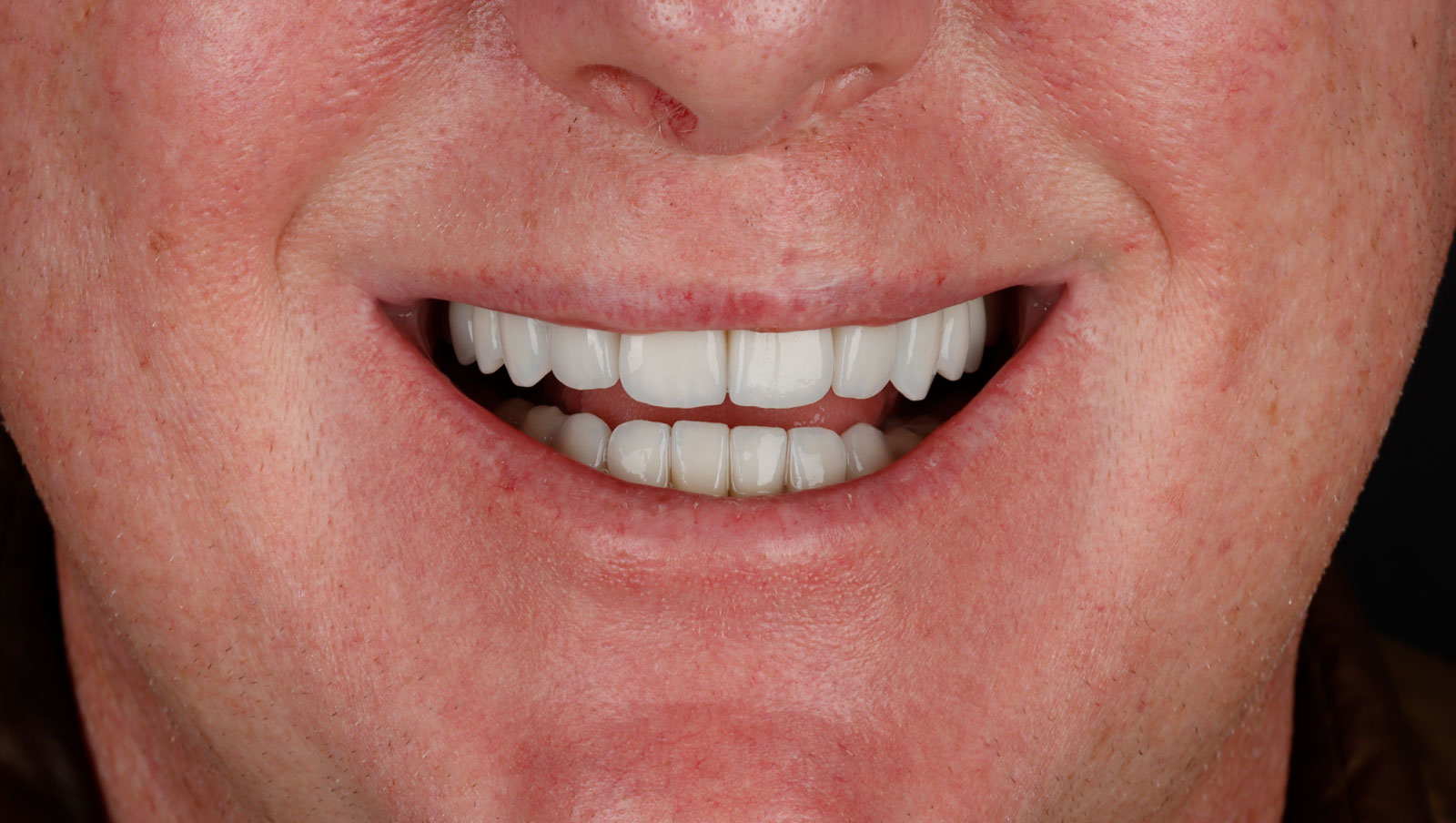 Close-up of the same man's relaxed smile after twenty e.max porcelain veneers on the upper and lower arches at La Costa Dental Excellence in Carlsbad, CA