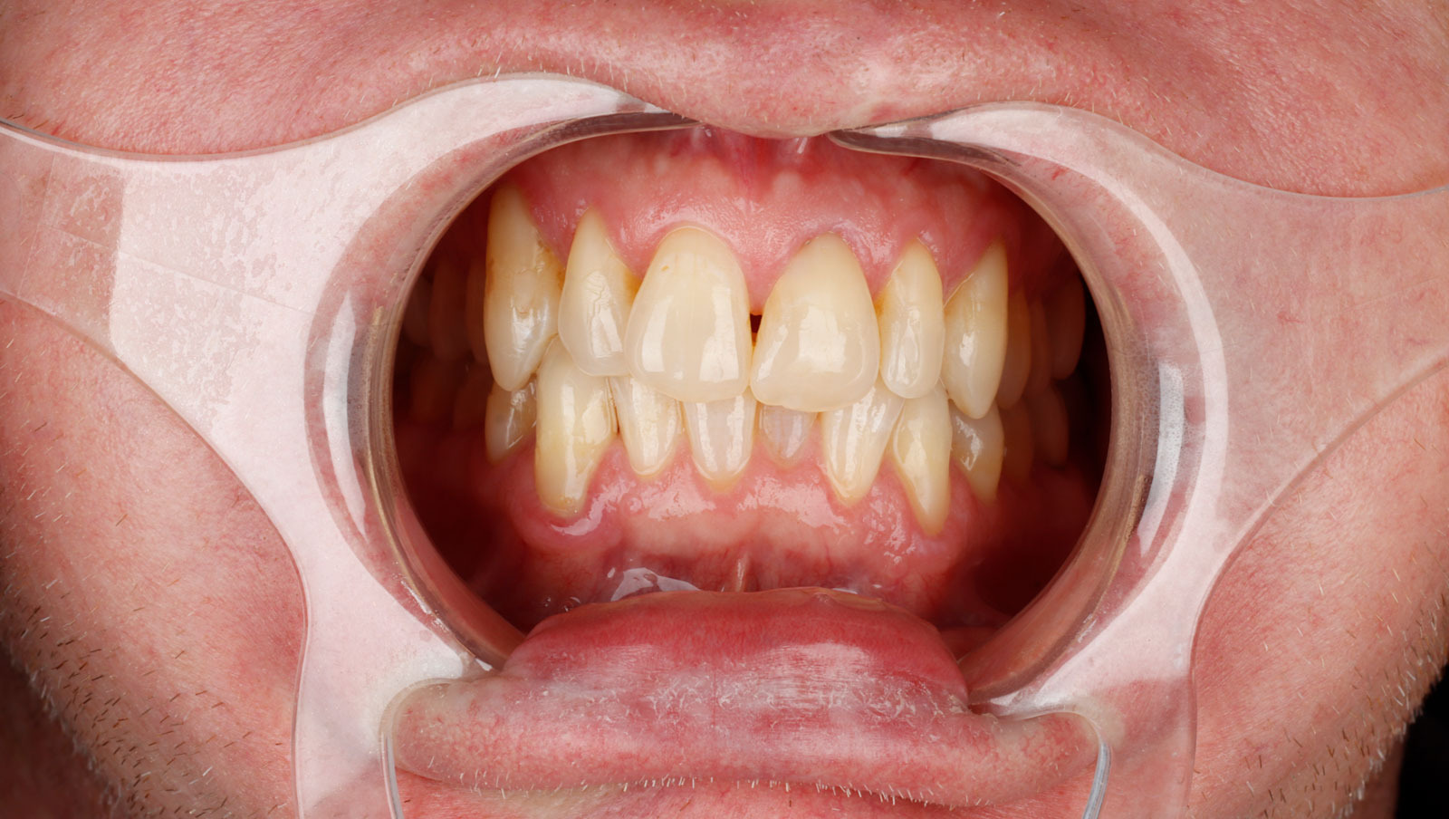 Retracted clinical photograph of a man's teeth before porcelain veneer treatment, showing crowding, worn edges, and yellow discoloration across both arches, at La Costa Dental Excellence in Carlsbad, CA