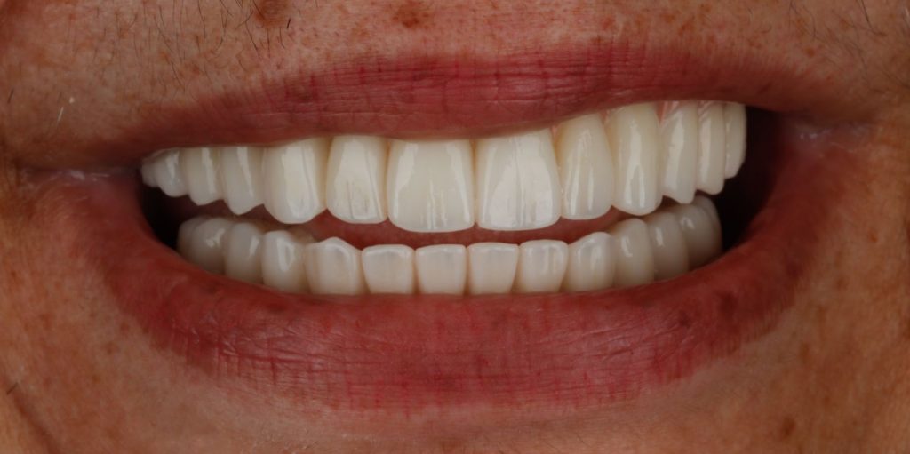 Close-up of the same woman’s smile after new fixed implant dentures on both arches at La Costa Dental Excellence in Carlsbad, CA