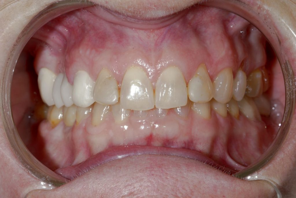 Close-up of a woman’s smile with older crowns, bridges, and veneers before replacement at La Costa Dental Excellence in Carlsbad, CA