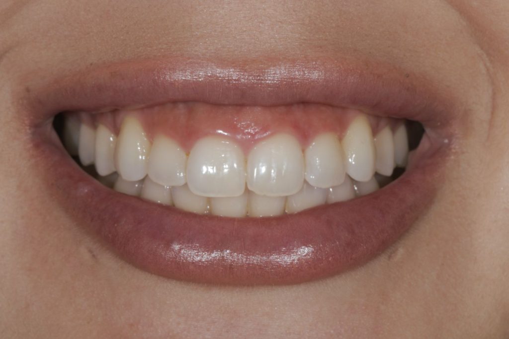 Close-up of a woman’s gummy smile with short-looking upper front teeth before treatment at La Costa Dental Excellence in Carlsbad, CA