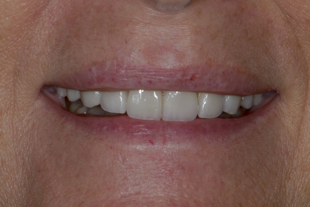 Close-up of the same woman’s smile after new crowns, bridges, and veneers in a natural shade at La Costa Dental Excellence in Carlsbad, CA