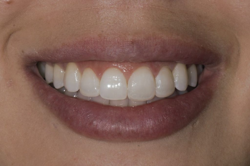 Close-up of the same woman’s smile after gum contouring and cosmetic bonding on the four upper front teeth at La Costa Dental Excellence in Carlsbad, CA