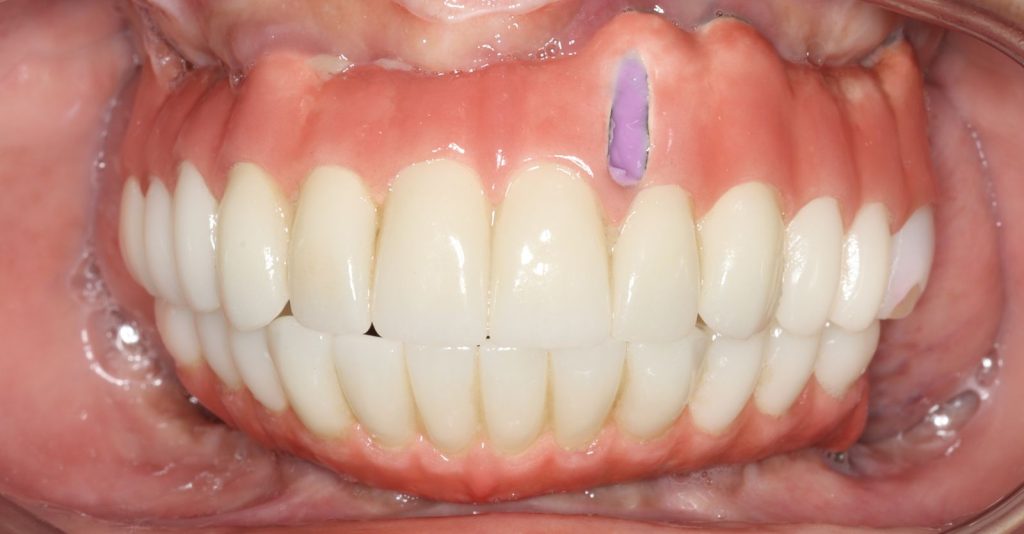 Close-up of a woman’s smile with her previous upper and lower implant dentures, before treatment at La Costa Dental Excellence in Carlsbad, CA